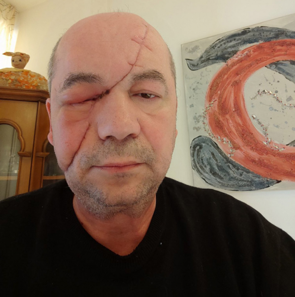 Мариуполец, потерявший глаз и семью из-за российских обстрелов - Общество
