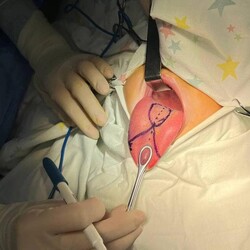 В Киеве врачи сделали сложную операцию ребенку, у которого язык был в пять раз длиннее - Общество
