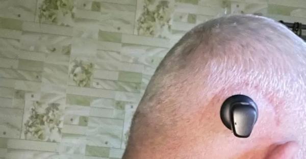 Львовские врачи вживили бойцу ВСУ слуховой аппарат в череп - Общество