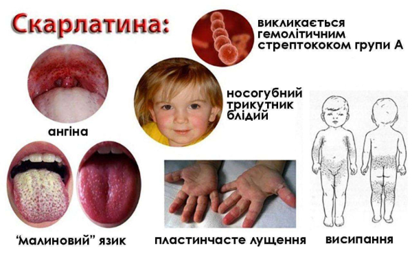 Детская болезнь с осложнениями: после скарлатины можно получить отит и ревматизм - Общество
